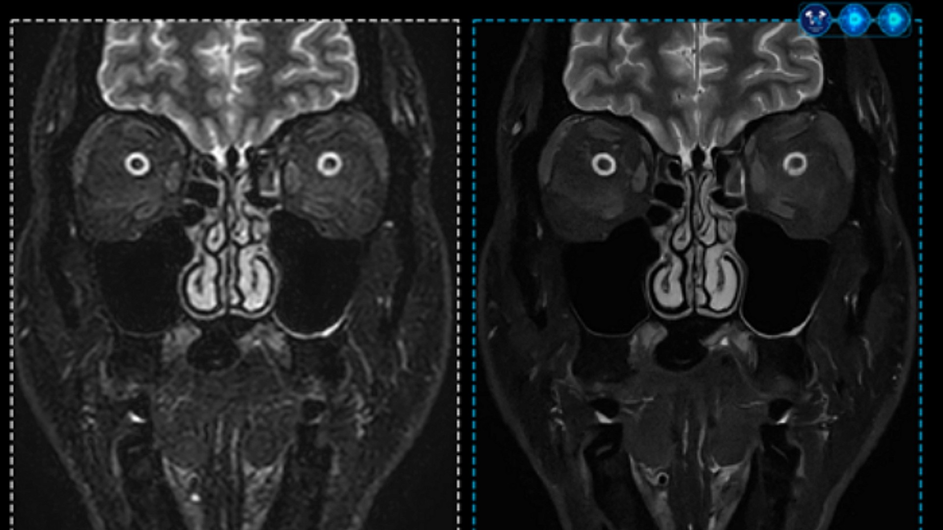 Philips Unveils MR SmartSpeed Precise with Dual AI Engine at KCR